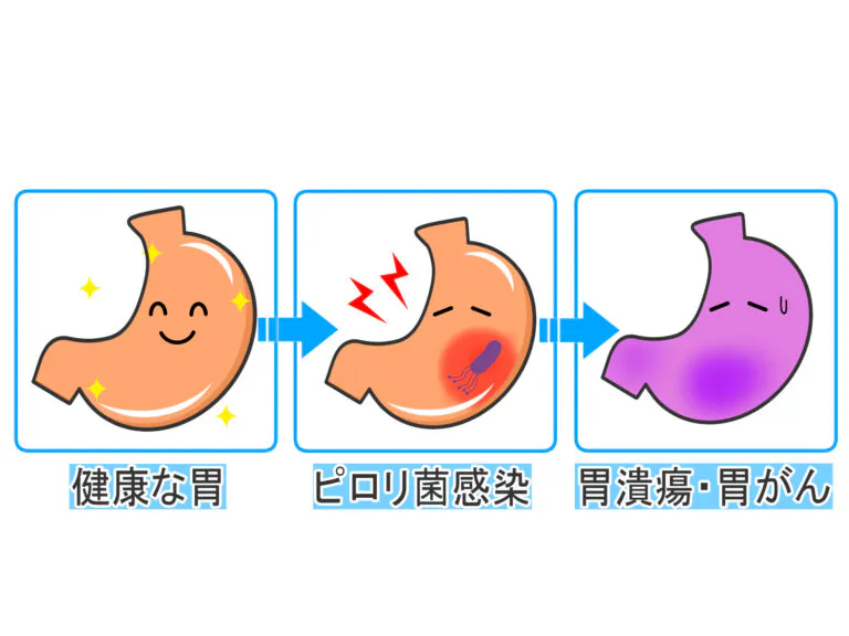 ピロリ菌から胃癌を発症する説明画像