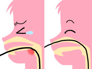 胃カメラを口から挿入するか鼻から挿入するかの説明画像