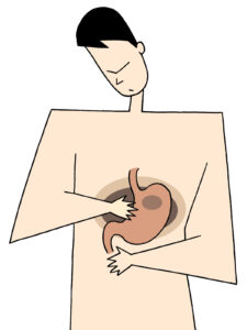 胃癌のイメージ画像